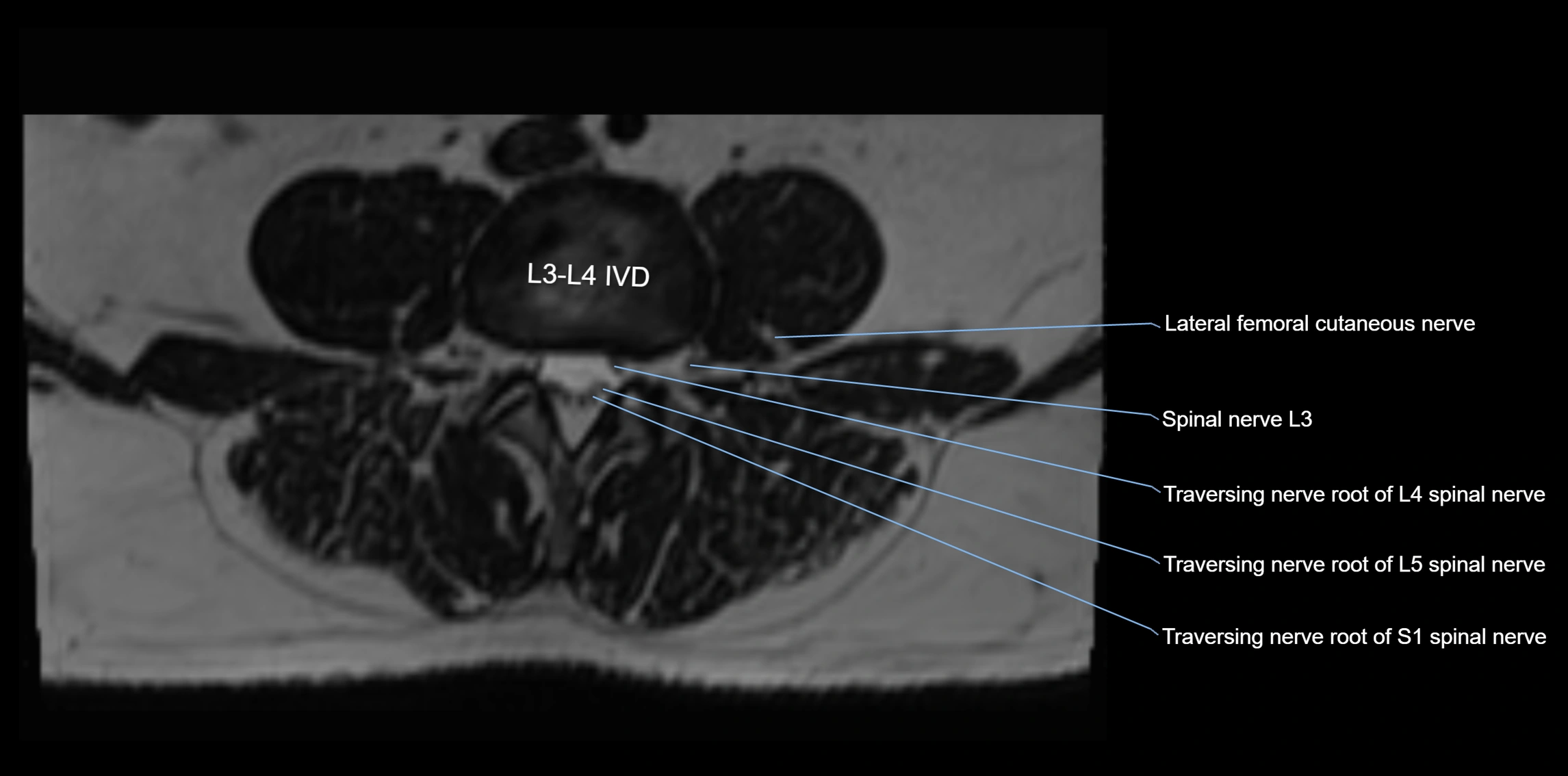 MR lumbosacral plexus axial cross sectional anatomy 3T  radiology  image-img-1008001-00031.webp
